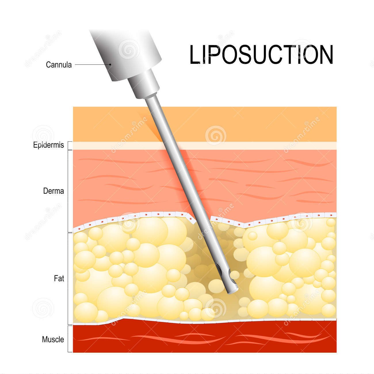 Dott. Di Mascio - Chirurgo Plastico | Chirurgia Estetica Liposcultura o Liposuzione