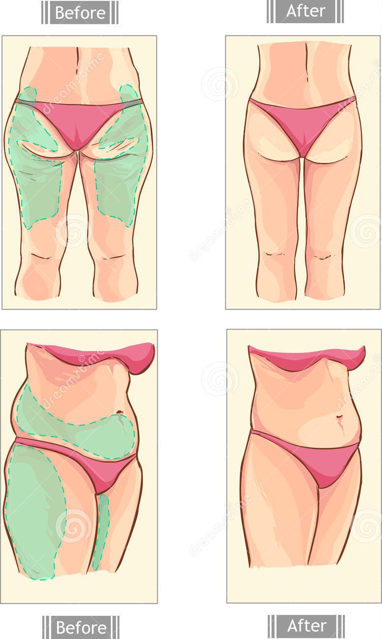 Chirurgia Estetica - Intervento di liposcultura o liposuzione nelle cosce o nell'addome
