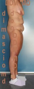 Addominoplastica Laterale Dx prima