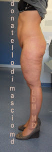 Addominoplastica Laterale Sx prima