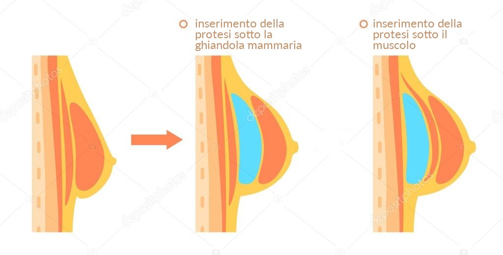 Dott. Di Mascio - Chirurgo Plastico | Chirurgia Estetica Aumento del Seno (Mastoplastica Additiva)