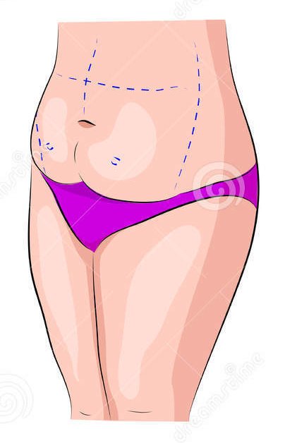 Dott. Di Mascio - Chirurgo Plastico | Chirurgia Estetica Liposcultura dell'addome