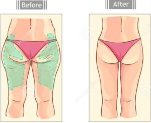 Liposcultura gambe e cosce