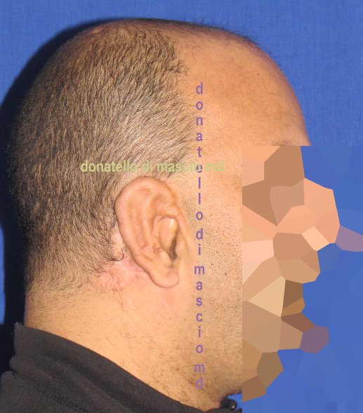 Chirurgia dell'Orecchio - Lesioni Auricolari Congenite | Malformazione Auricolare Dopo l'intervento