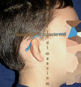 Chirurgia dell'Orecchio - Lesioni Auricolari Congenite | Malformazione Auricolare Prima dell'intervento