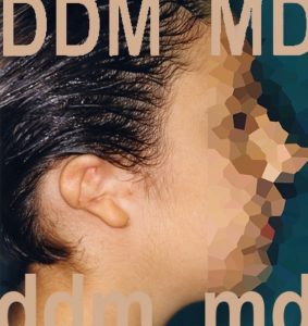 Chirurgia dell'Orecchio | Microtia prima