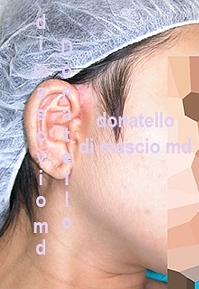 Chirurgia dell'Orecchio - Lesioni Auricolari Congenite | Malformazione Auricolare Dopo l'intervento