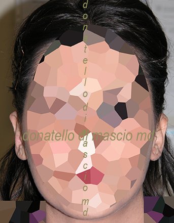 Chirurgia Estetica Orecchio | Orecchie a Sventola - Dopo l'intervento
