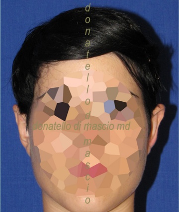 Chirurgia Estetica Orecchio | Orecchie a Sventola anteriore - Dopo l'intervento