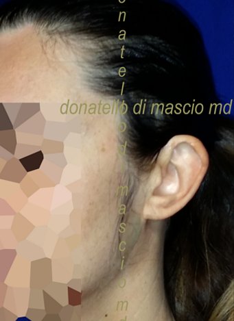 Chirurgia Estetica Orecchio | Orecchie a Sventola laterale sinistra - Prima dell'intervento