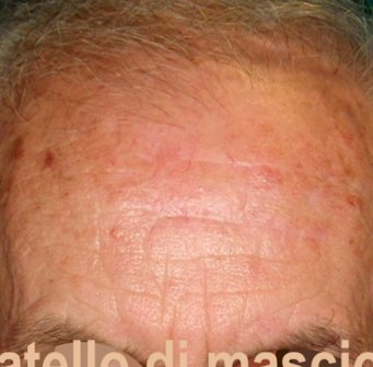 Chirurgia Plastica Ricostruttiva | Oncoplastica - Epitelioma Dopo l'intervento