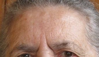 Medicina Estetica – Rughe Glabellari