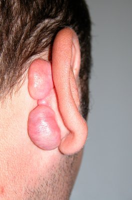 Chirurgia Ricostruttiva dell'Orecchio - Lesioni Auricolari Acquisite - Cheloidi