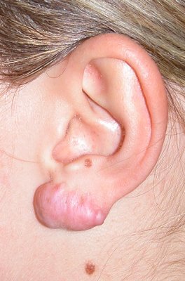 Chirurgia Ricostruttiva dell'Orecchio - Lesioni Auricolari Acquisite - Cheloidi