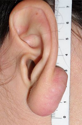 Chirurgia Ricostruttiva dell'Orecchio - Lesioni Auricolari Acquisite - Cheloidi