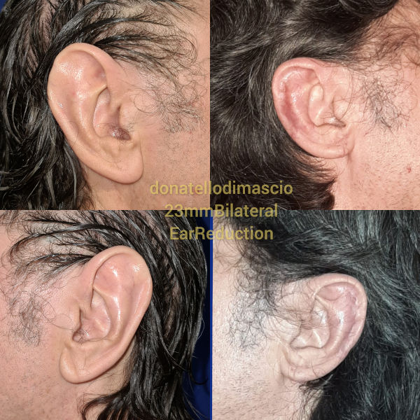Orecchio Grande (Macrotia) Riduzione -  Prima e Dopo l'intervento